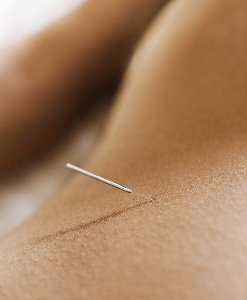 Close-up of a single fine acupuncture needle placed gently on a patient's back
